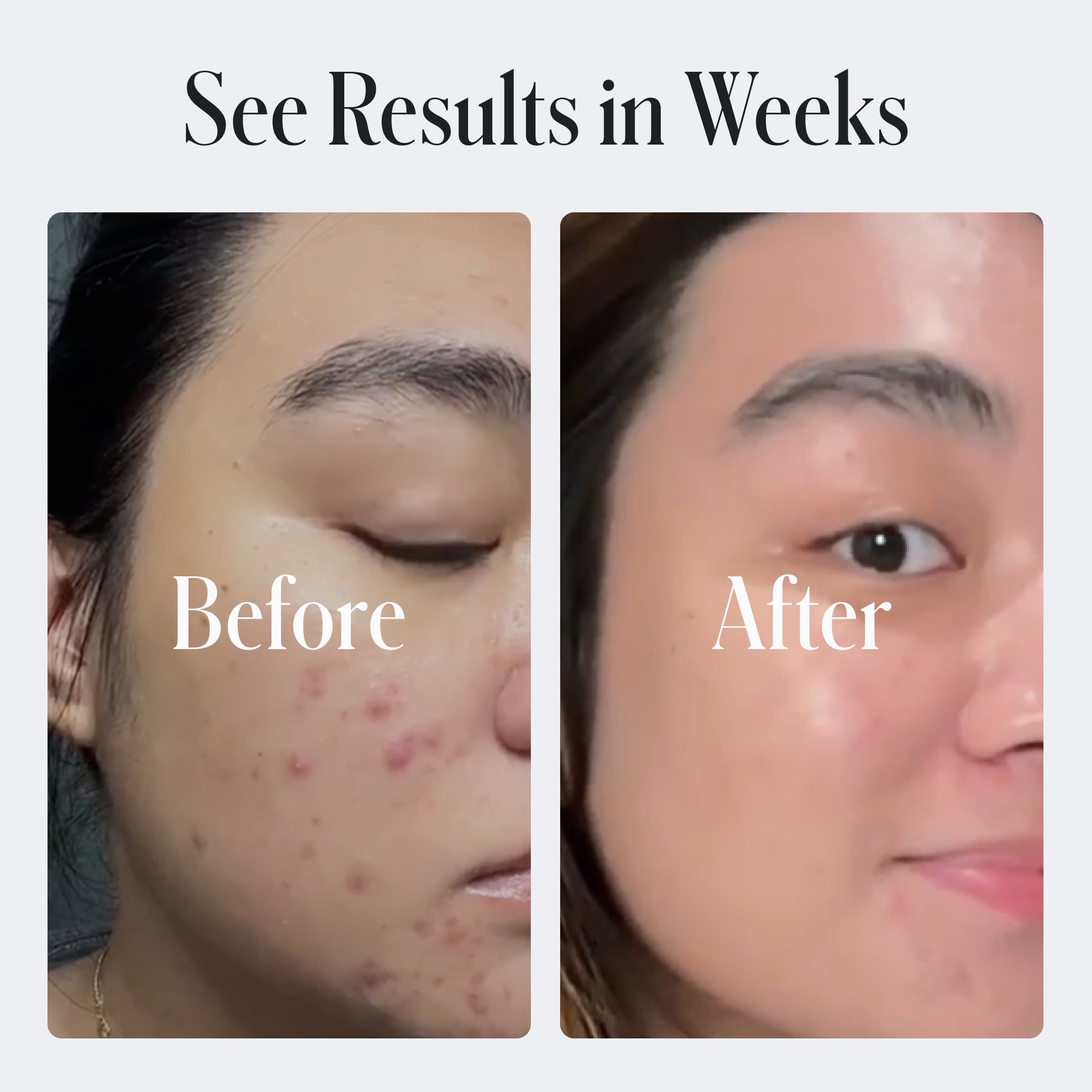 Clear System Acne Duo