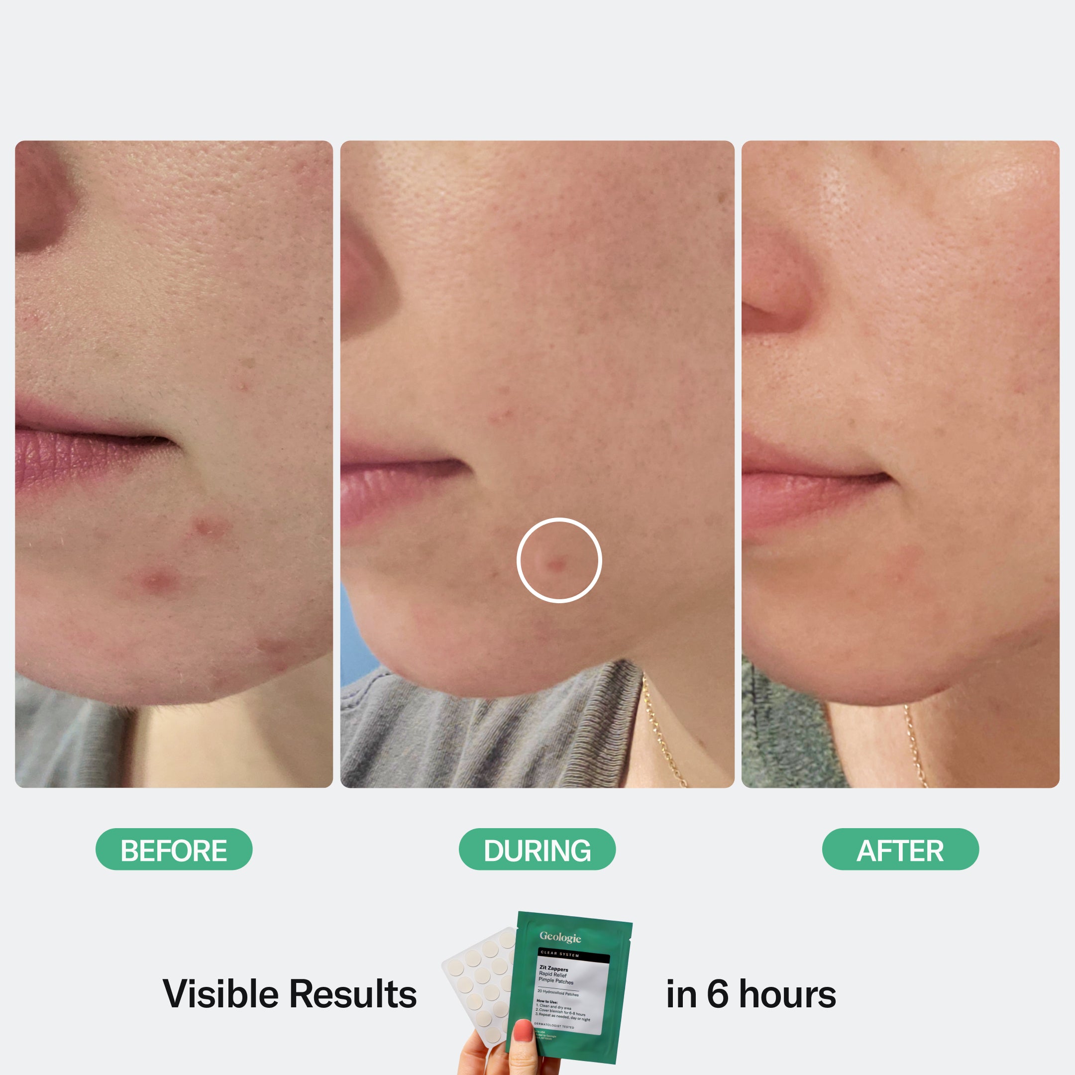 Three-stage progression of skin treatment, showing before, during, and after photos with improved complexion over time thanks to Geologie's Zit Zapper Pimple Patches.