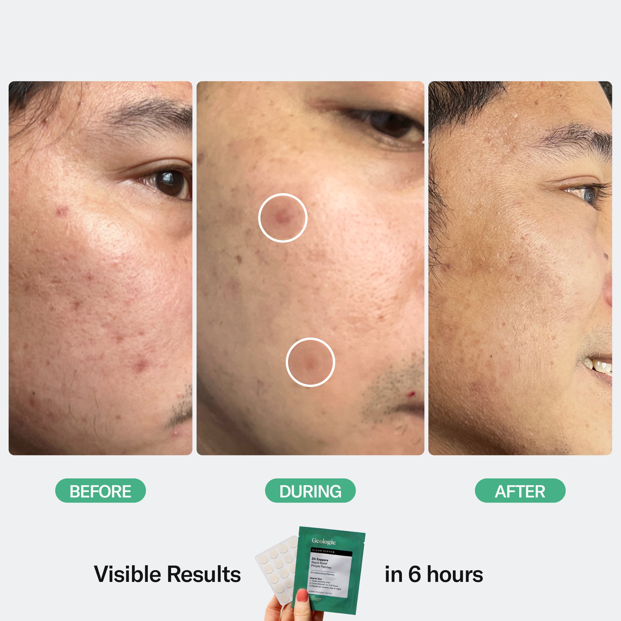 Before, during, and after treatment comparison of acne on a person's skin, showing visible results in 6 hours using Geologie's Zit Zapper Pimple Patches.