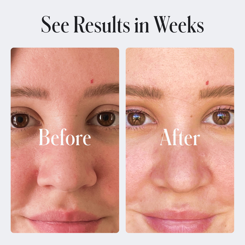 Side-by-side close-ups labeled 'Before' and 'After,' reveal reduced redness and clearer skin after using Geologie's Skin Repair Moisturizer with hyaluronic acid, under the text: 'See Results in Weeks.
