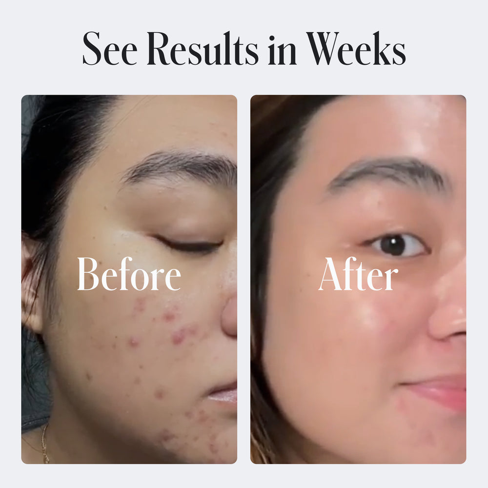 Side-by-side photos show a cheek with acne in the 'Before' image and clearer skin after using Geologie Clear Skin Face Cream in the 'After' image, captioned 'See Results in Weeks.