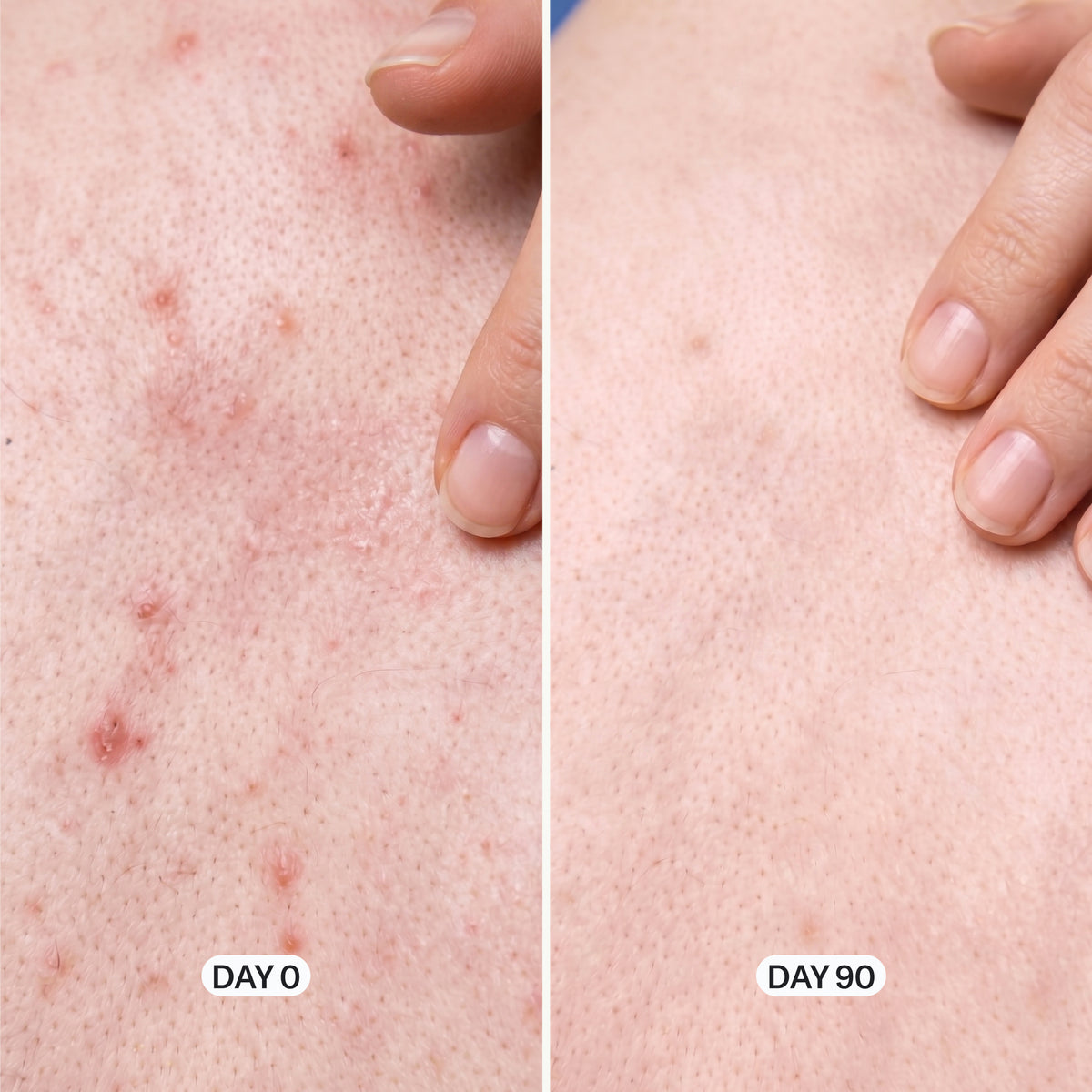 Acne Control Body Wash