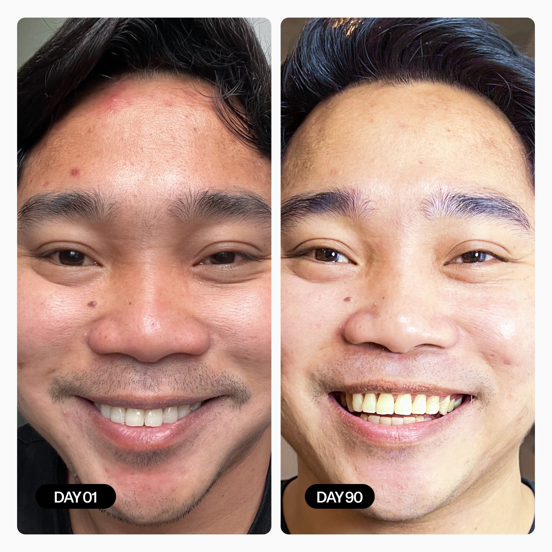 Male Before & After - Acne Improvements for Him