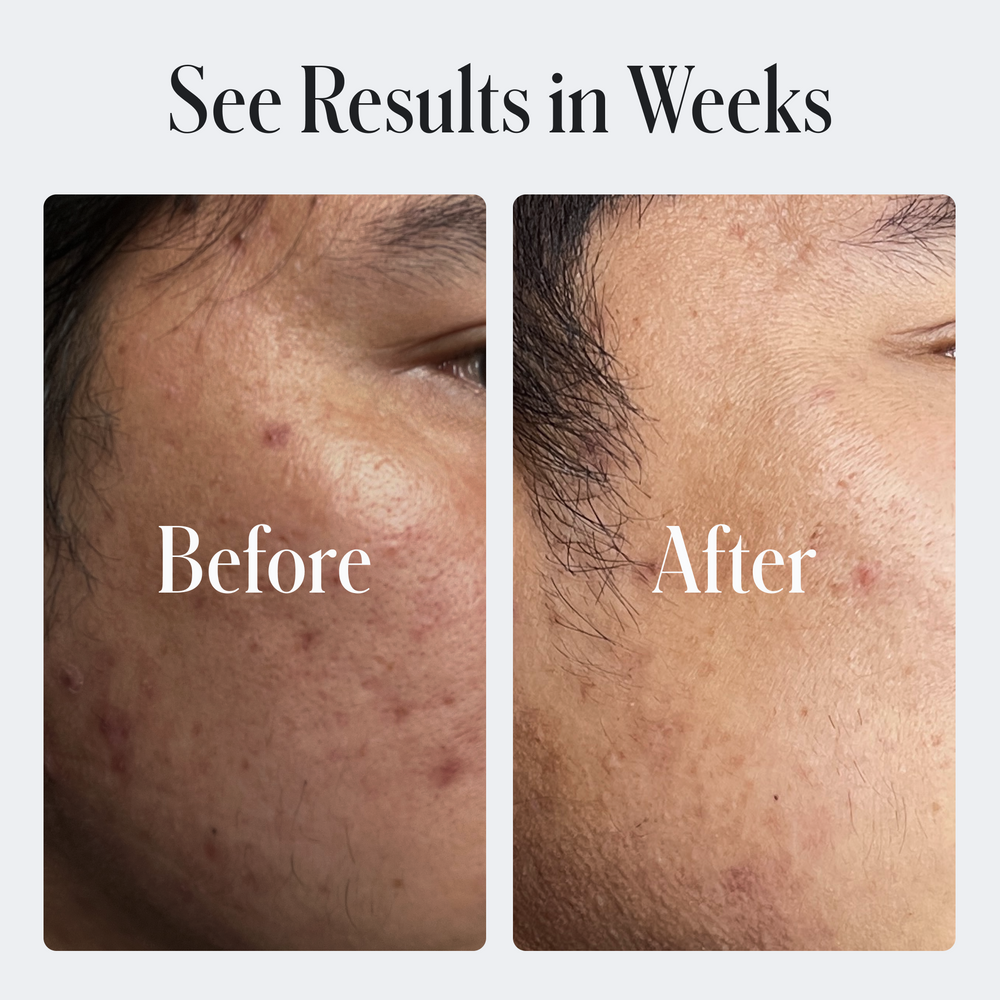 Side-by-side close-up images of a person's cheek with acne blemishes in the 'Before' picture and clearer skin in the 'After' picture. Text reads, 'See Results in Weeks with Geologie's Skin Repair Moisturizer.