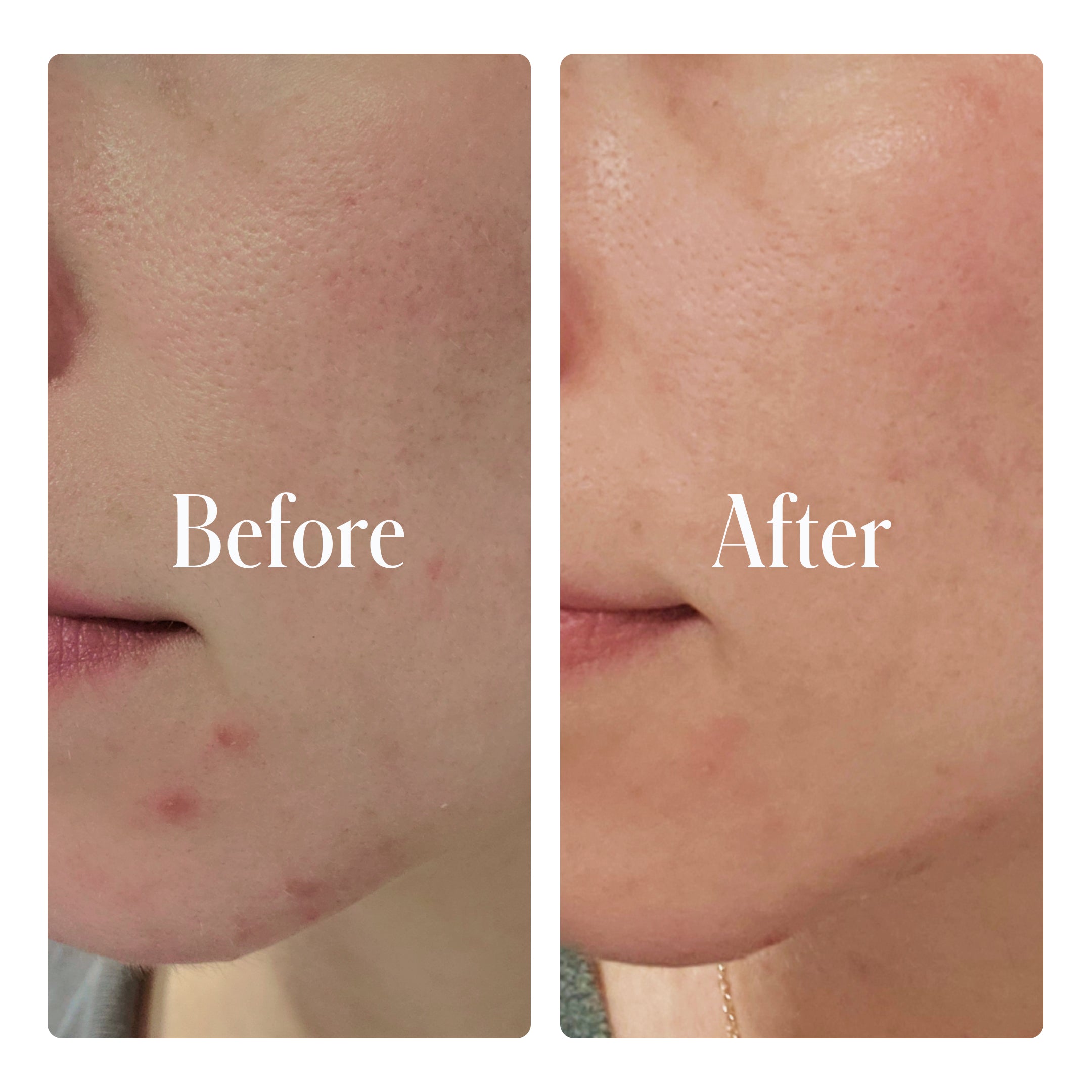 A side-by-side comparison showcases a person's cheek and chin before and after using Geologie's Clear System Set, highlighting reduced redness and blemishes in the 