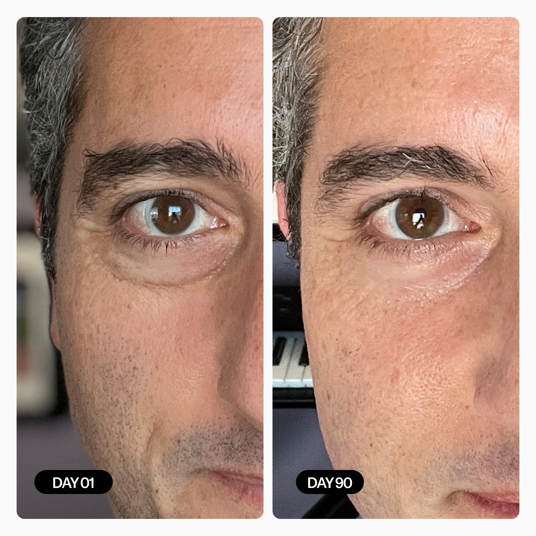 Male Before & After - Dark Circles Under Eye Area