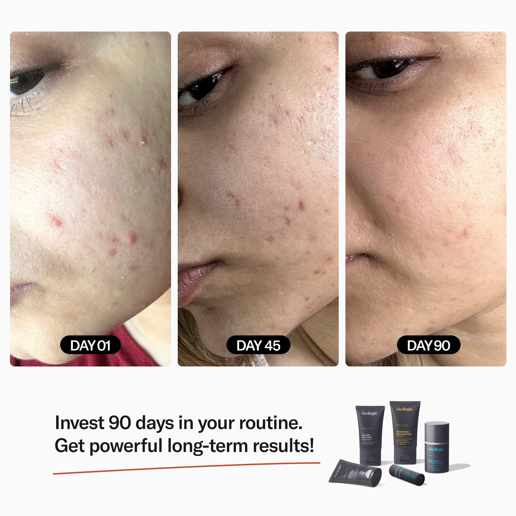 Geologie Female Before + After Displaying Improved Acne and Clearer Skin - Invest 90 Days in your skincare routine to get powerful, long-term Results