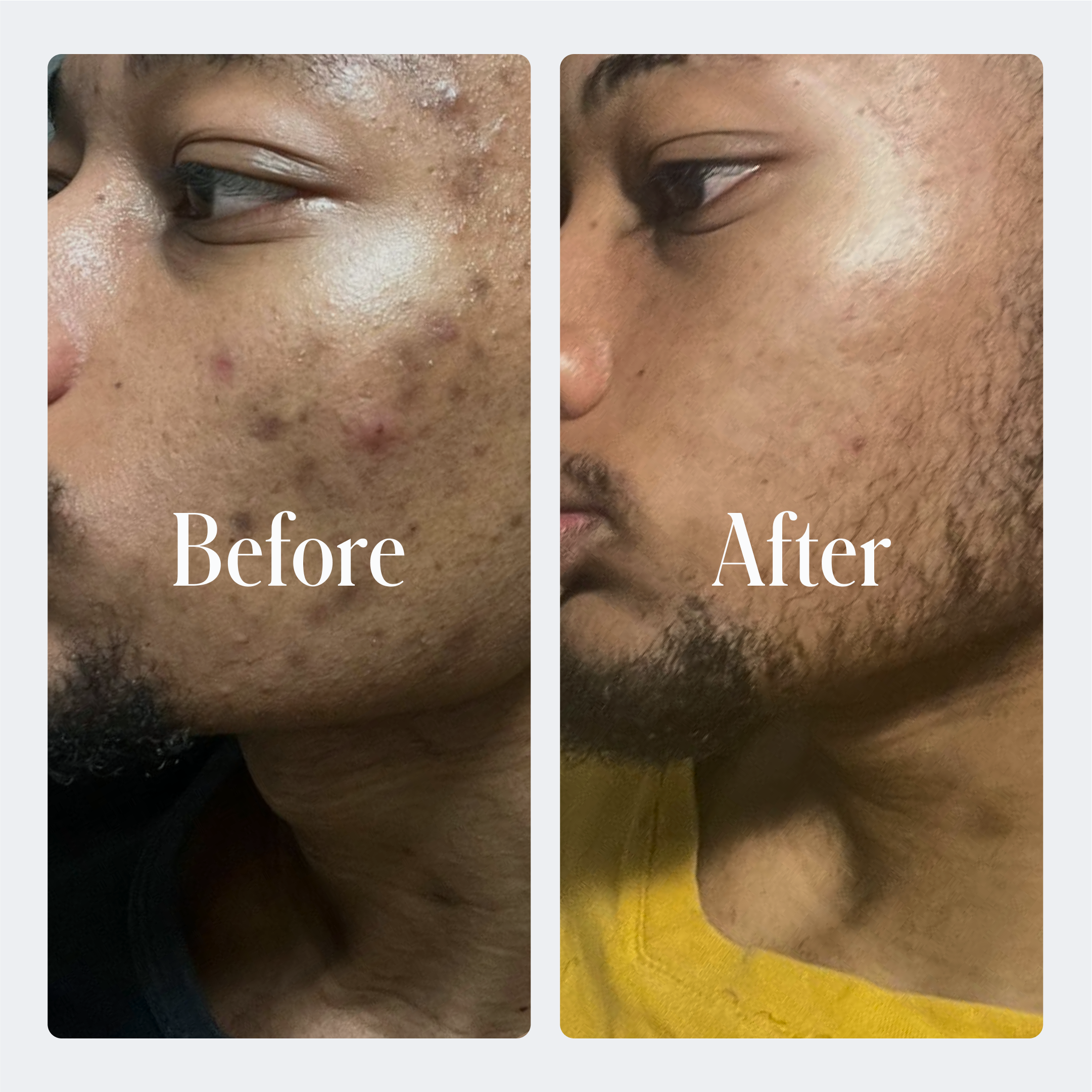 Geologie Acne Starter Kit